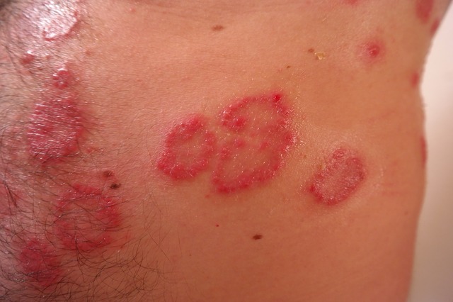 psoriáza, pokožka, zápal,.jpg